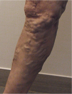 정맥 혈관이 심하게 돌출된 진행성 하지정맥류 모습