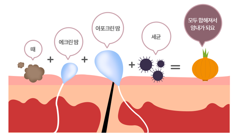 액취증 원인 이미지